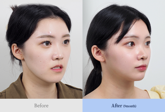 양악 + 윤곽(광대,턱끝)